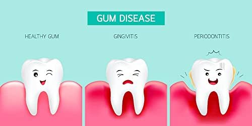 Ounce Tube (Without Boil and Bite Trays); Hydrogen Peroxide Periodontal Treatment| Oral Cleansing Gel. Mint Flavor| Promotes Teeth Whitening | Treatment for Oral HealthQ