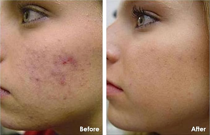 Best Acne Treatment for Face with Vitamin C for Men & Women. Use Acne Spot Treatment for Face for a Clear & Fresh Skin without Breakouts, Redness, Blemishes or Acne Scars. Results in 4 Weeks - 1 Fl Oz